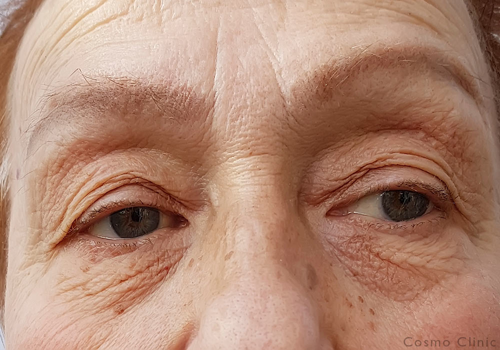 Pasientcase: kvinne slitne øyne