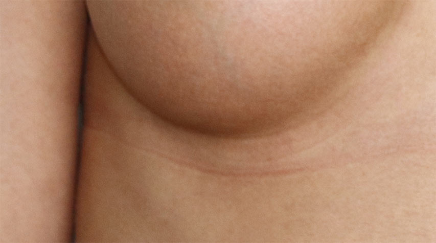 Bryst uten arr (transaxillær brystforstørring)