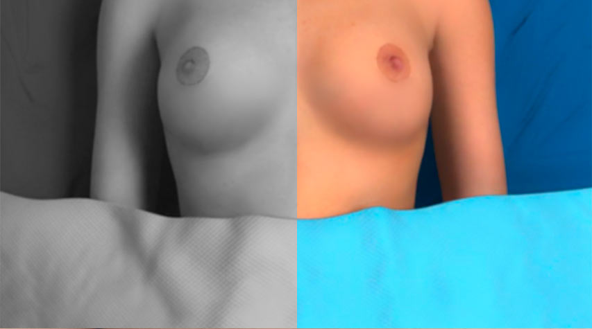 brystoperasjon før etter bilder