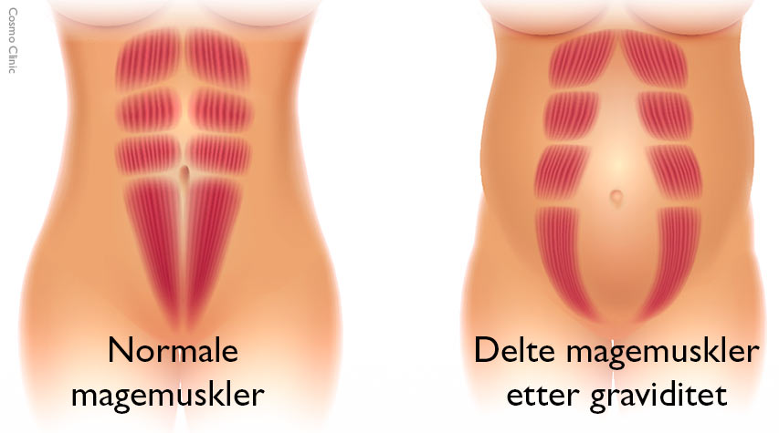 illustrasjon som viser delte magemuskler (rectusdiastase)