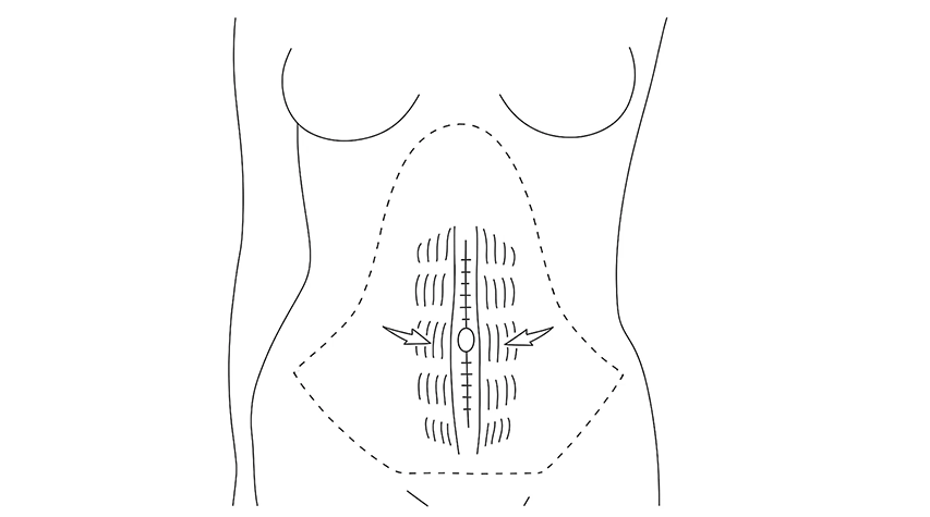 rektusdiastase bukplastikk