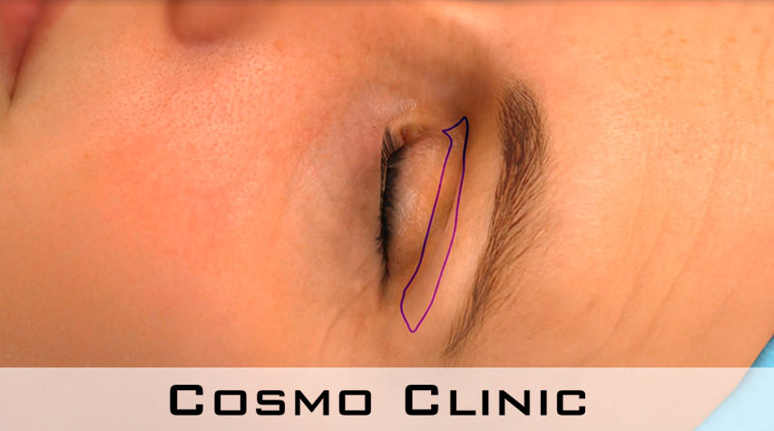 markering av hud som skal fjernes ved øyelokkoperasjon for tunge oyelokk 