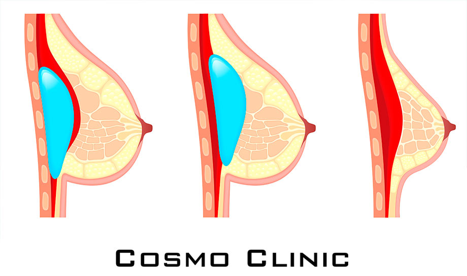 920x545 Cosmo protese bryst3 logo